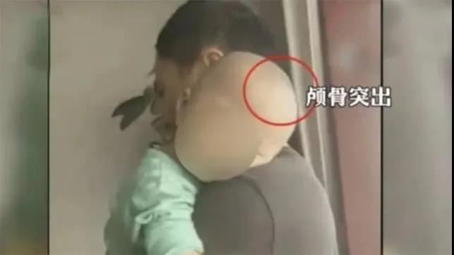國家市場監(jiān)管總局要求徹查“大頭娃娃”事件，消費(fèi)者需正確選購和使用特殊醫(yī)學(xué)用途配方食品(圖2)